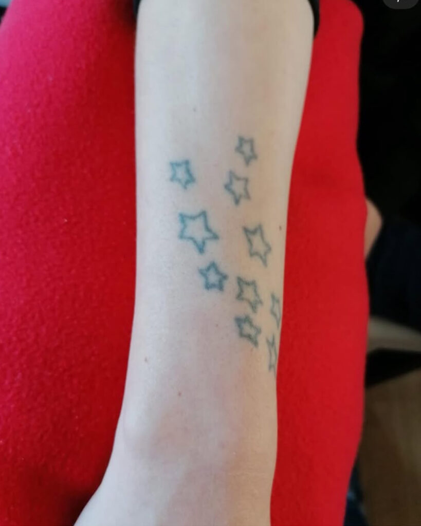 tattoo remove